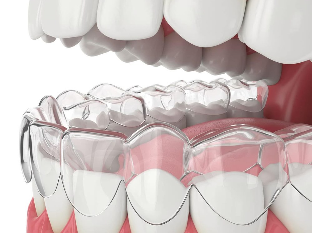 Капи Invisalign — новітнє досягнення в стоматології для ідеальної посмішки