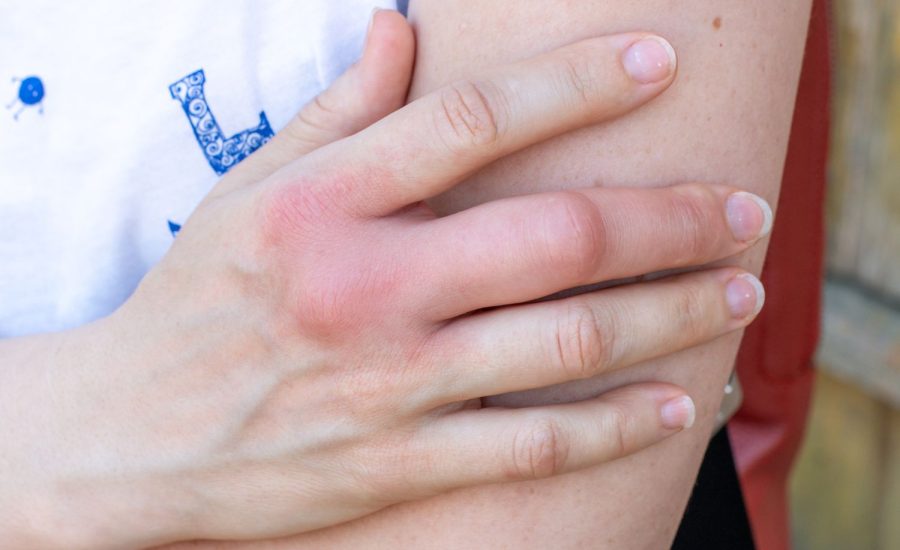 Що робити, якщо палець посинів, набряк і болить від удару