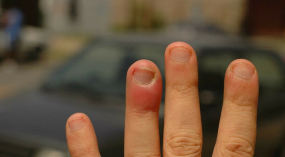 Чи можна парити нарив на пальці руки або ноги: що про це говорять лікарі