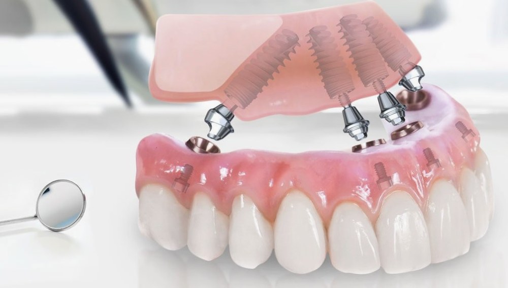 протезування зубів в Одесі brillant.dental