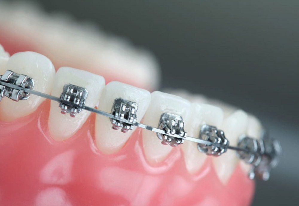 протезування зубів в Одесі brillant.dental